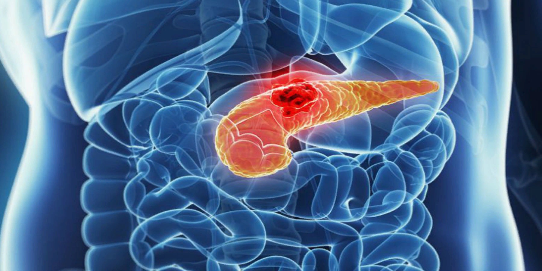 Острый панкреатит: симптомы, причины и методы лечения