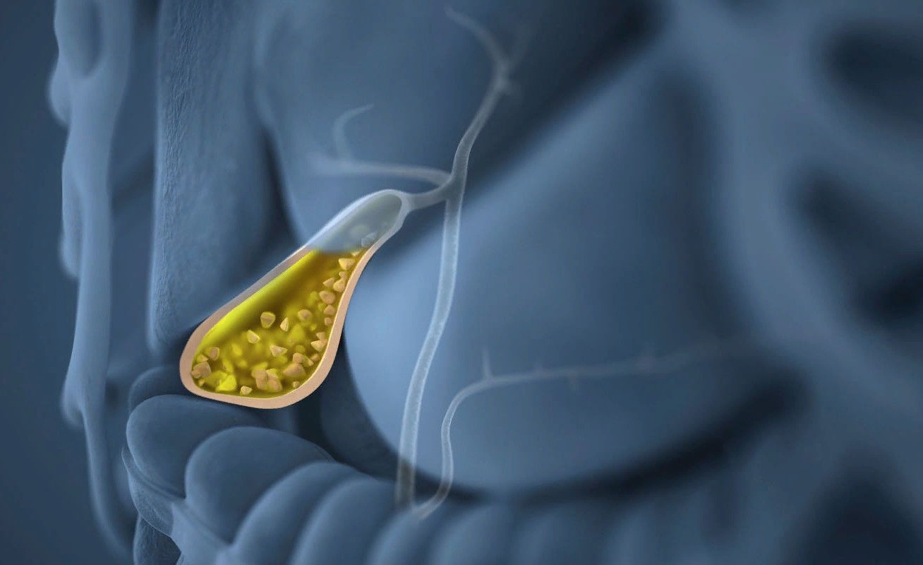 Лапароскопическая холецистэктомия: проведение операции и восстановление после нее