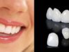 Цирконий или металлокерамика: что выбрать при реставрации зубов
