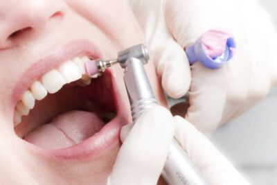 Особенности профессиональной чистки зубов