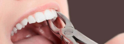 Устаревшие мифа об удалении зубов