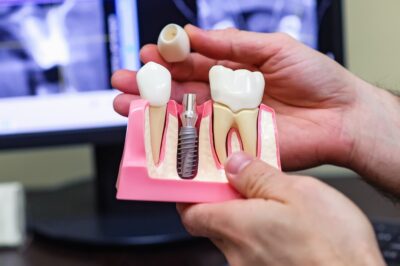 Имплантация зубов: сроки, стоимость, реабилитация