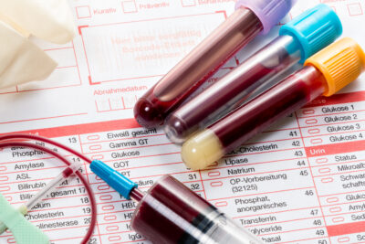 Биохимический анализ крови: как подготовиться к сдаче?