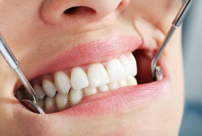 Что представляет собой протезирование зубов? Показания к проведению процедуры