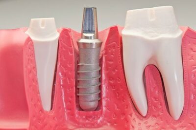 Установка зубных имплантов: когда необходима и почему?