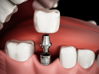 Имплантация зубов: виды и достоинства