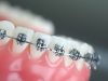 Как брекеты помогают исправить прикус, преимущества установки брекетов