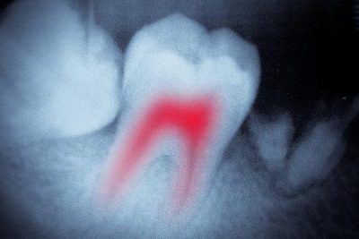 Лечение кисты зуба: методы, преимущества и процедура